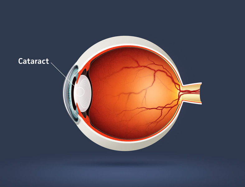 cataract vision night